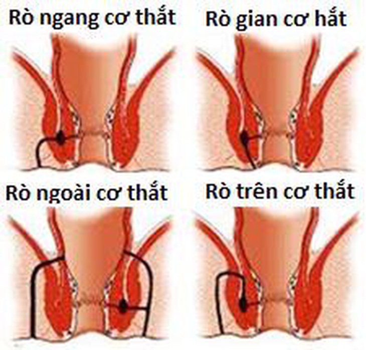 Điều trị rò hậu môn (mạch lươn) bằng phương pháp phẫu thuật - Ảnh 2.