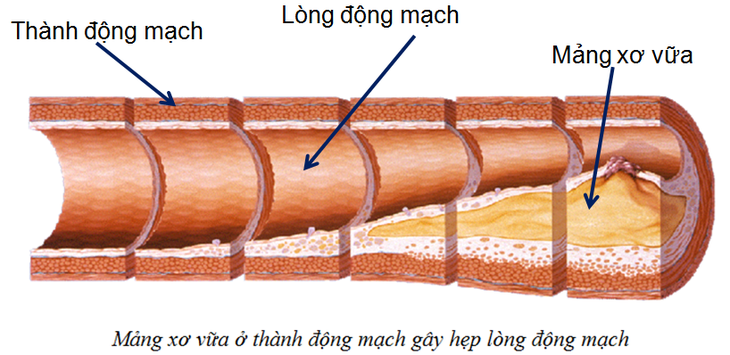 Chương trình tư vấn: Những điều cần biết về bệnh động mạch vành - Ảnh 4.