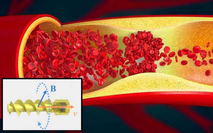 Robot siêu nhỏ ‘bơi’ trong cơ thể xử lý các cục máu đông