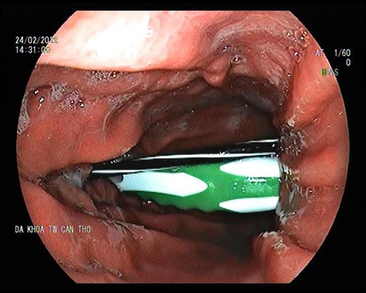 Nội soi lấy ruột bút bi và bàn chải trong dạ dày nam bệnh nhân - Ảnh 1.