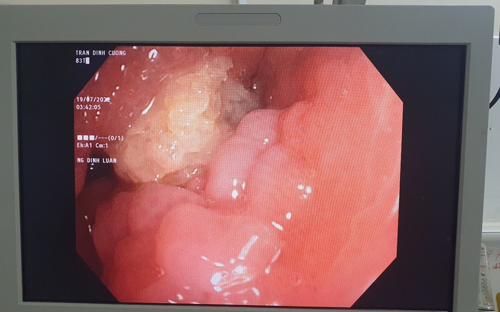 Gắp dị vật "găm" vào phế quản cho cụ ông bị viêm phế quản, viêm phổi hậu COVID-19