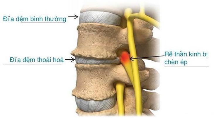 Mới ngoài 20 phát hiện thoái hóa đĩa đệm - Ảnh 1.