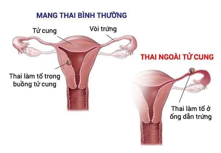 Hình ảnh tử cung khi mang thai bình thường và thai ngoài tử cung - Ảnh minh họa