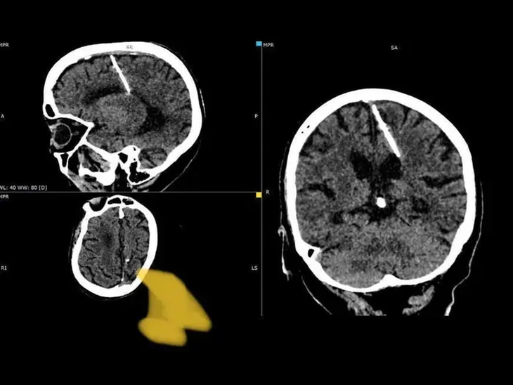 Ảnh chụp cây kim dài gần 3cm trong não bà cụ 80 tuổi - Ảnh: INSIDER