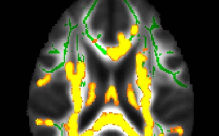 Mỡ bụng cảnh báo bệnh Alzheimer?