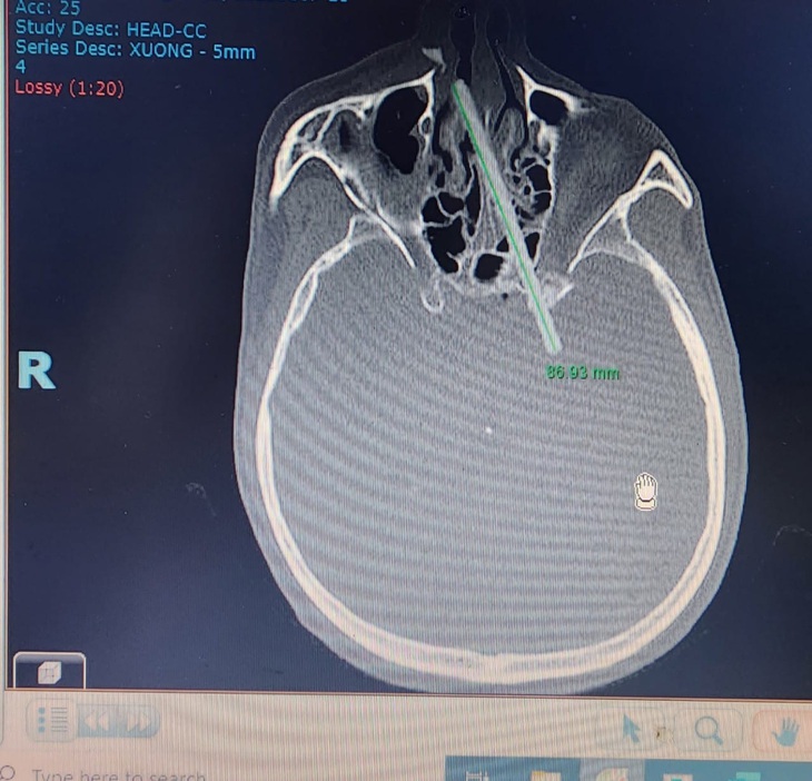 Phim chụp hộp sọ bệnh nhân có chiếc đũa găm vào qua hốc mũi 5 tháng trước - Ảnh: NGUYỄN VĂN MẬN