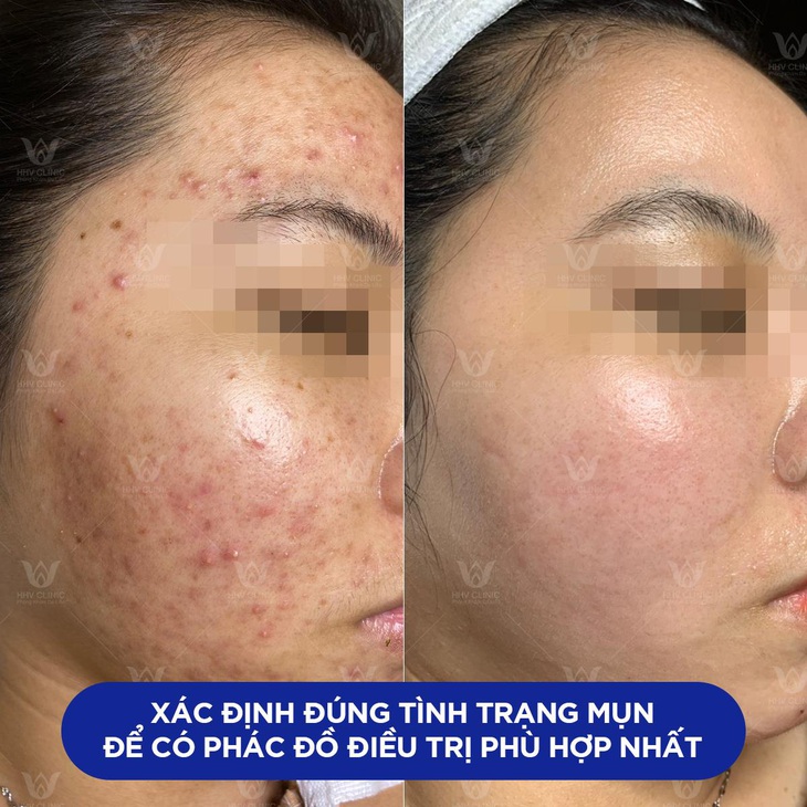 Phòng khám da liễu HHV Clinic - Nơi điều trị thâm mụn - Ảnh 1.