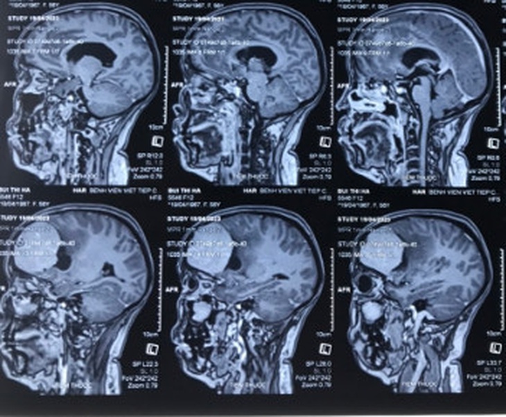 Tưởng bị thiếu máu não, đi khám phát hiện u màng não lớn- Ảnh 2.