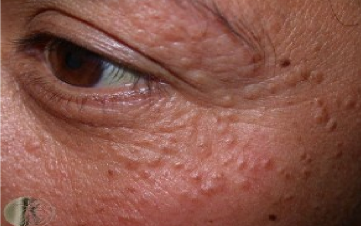 Bị ban vàng mí mắt là do rối loạn lipid máu? - Ảnh 1.