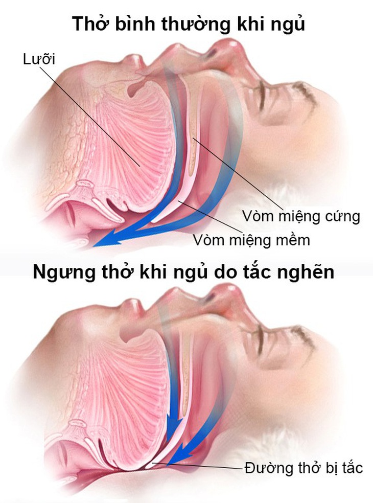 Biểu hiện của ngưng thở khi ngủ - Ảnh BSCC