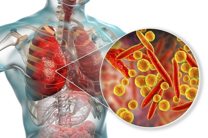 Bác sĩ cảnh báo bệnh do vi khuẩn Mycoplasma nếu không được phát hiện và điều trị đúng cách sẽ gây ra những biến chứng nguy hiểm cho người bệnh và có thể lây lan rộng ra cộng đồng - Ảnh: BVCC