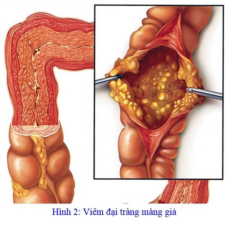 Hình ảnh mô phỏng viêm đại tràng giả mạc - Ảnh: BSCC