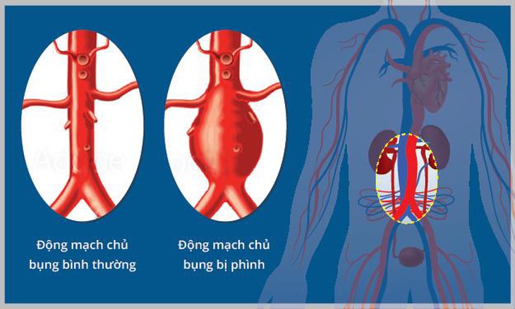 Phình động mạch chủ là một sát thủ thầm lặng và thường không có triệu chứng