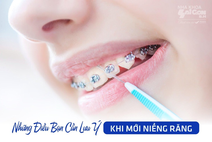 Bác sĩ nha khoa Sài Gòn B.H lưu ý những điều cần biết trước khi chỉnh nha - Ảnh 2.