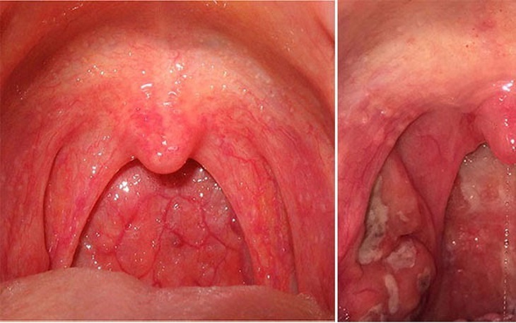 Chữa viêm họng không triệt để có thể biến chứng "khớp đớp tim"