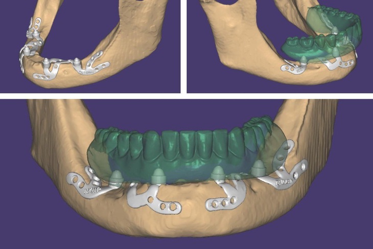 Kỹ thuật Implant cá nhân hóa được đánh giá là “tương lai” mới cho ngành Implant nha khoa Việt Nam