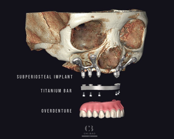 Mô phỏng cấu tạo của kỹ thuật cấy ghép Implant cá nhân hóa