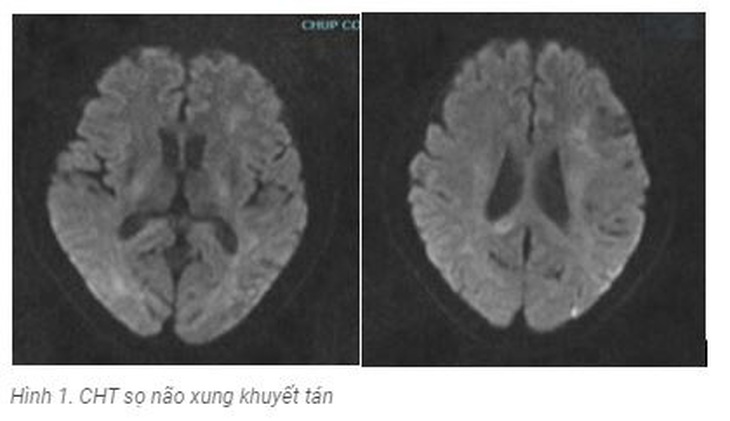 Hệ miễn dịch tấn công não bộ: Căn bệnh viêm não xa lạ dễ gây tử vong- Ảnh 2.