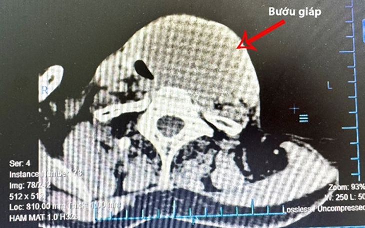 Phẫu thuật bóc khối bướu giáp to "giải cứu" khí quản cụ ông - Ảnh 2.