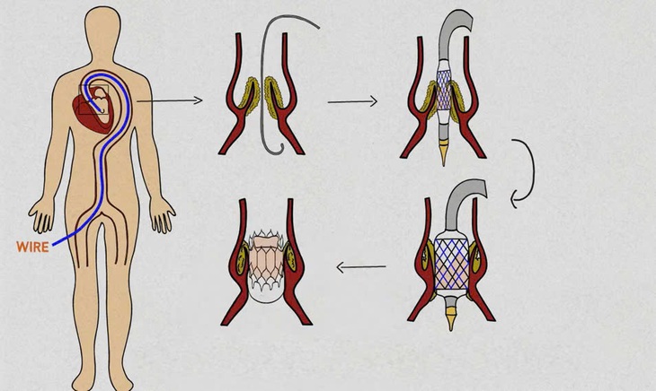 Cơ hội sống cho người mắc bệnh lý van tim nguy hiểm - Ảnh 1.