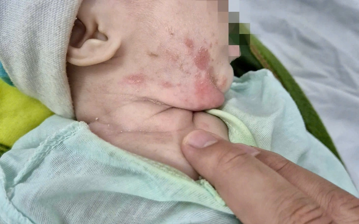 Trẻ 2 tháng tuổi mắc giang mai bẩm sinh, dễ nhầm bệnh ngoài da nhưng nguy hiểm - Ảnh 3.