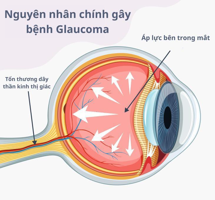 Nguyên nhân phổ biến khiến hàng triệu người trên thế giới mắc bệnh mù lòa- Ảnh 2.