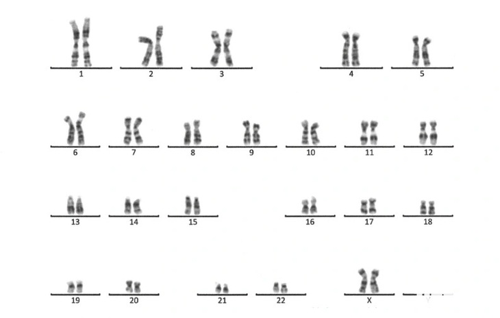 Nhiễm sắc thể đồ của bệnh nhân N. cho kết quả khảm hai dòng tế bào. Đây là dòng tế bào 46,XX - Ảnh: PT