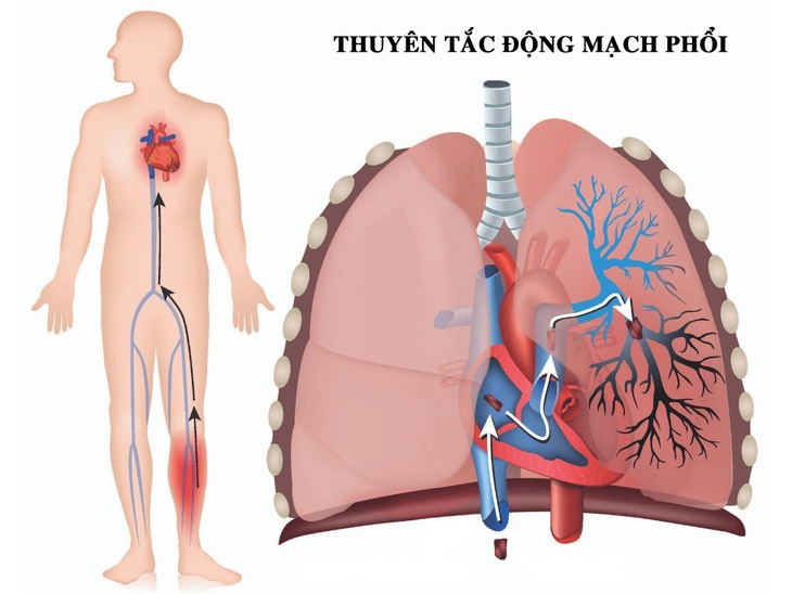 Ảnh minh họa - BVCC