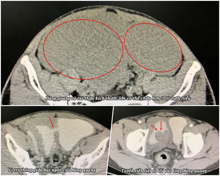 Hình ảnh túi thừa bàng quang và tiền liệt tuyến trên phim chụp - Ảnh: BVCC