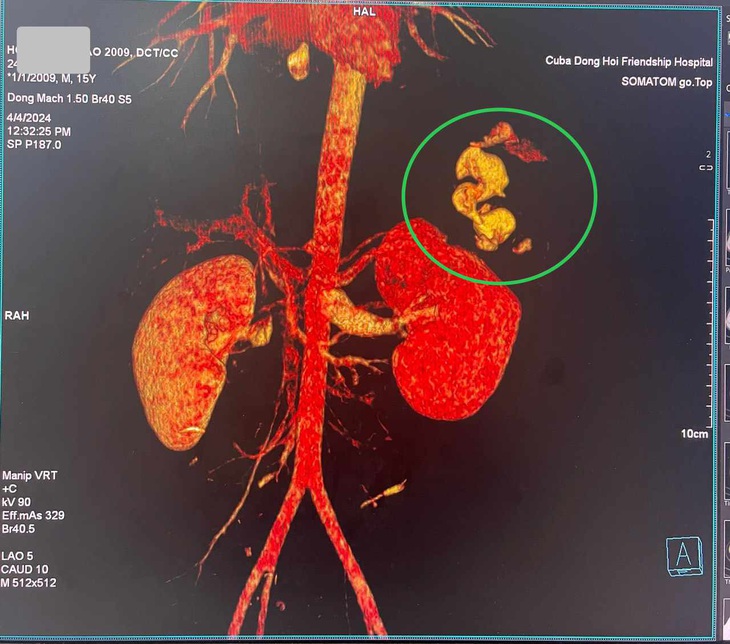 Chụp CT scan thấy tổn thương ở lách độ I - II. Chấn thương rách cực trên thận ổ lớn, xuyên vào nhu mô thận, đứt mạch máu gây chảy máu ồ ạt thành vòi - Ảnh: Đ.HÙNG