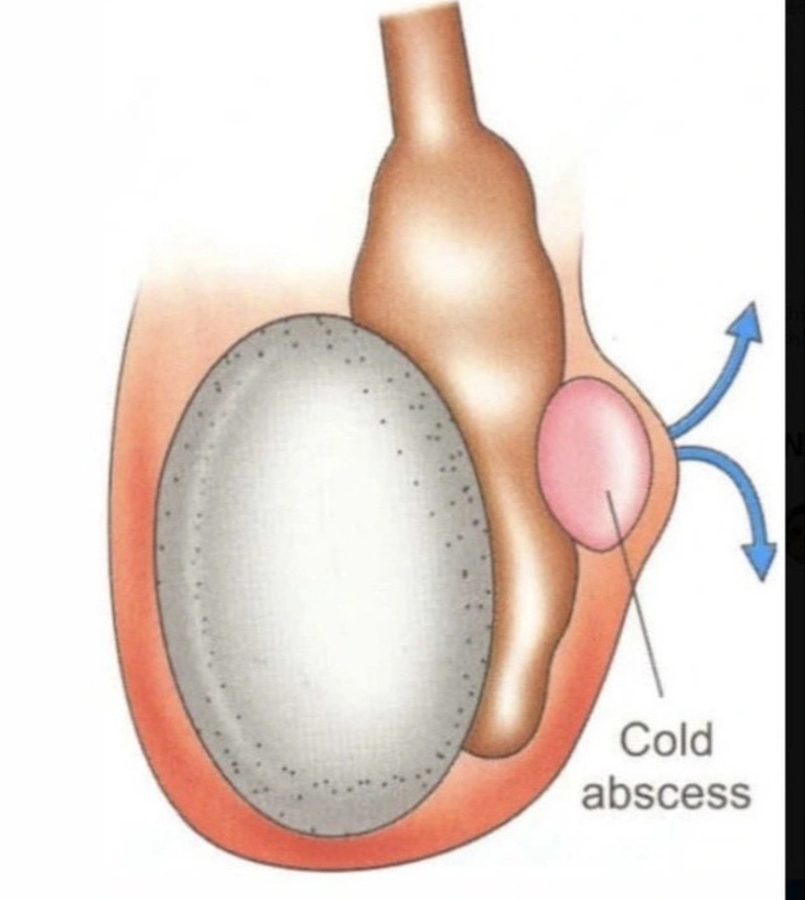 Áp xe mào tinh hoàn do vi khuẩn lao - Ảnh: BSCC