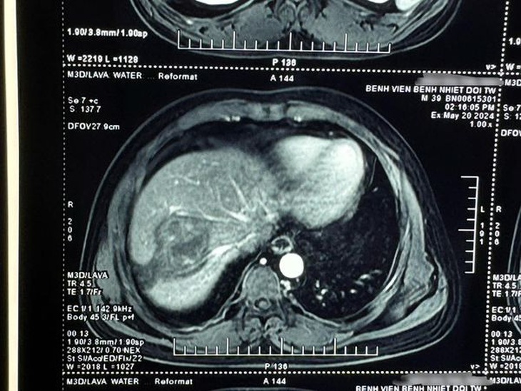 Khối u trong gan bệnh nhân trên phim chụp - Ảnh: BVCC