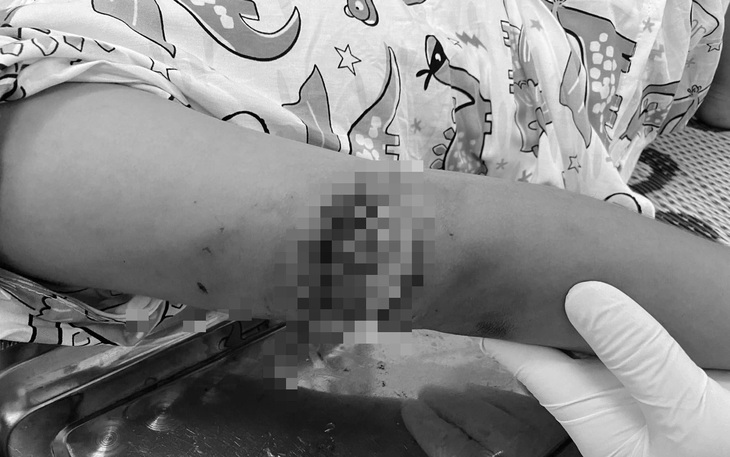 Sang nhà hàng xóm chơi, bé gái bị chó cắn thấu xương cánh tay