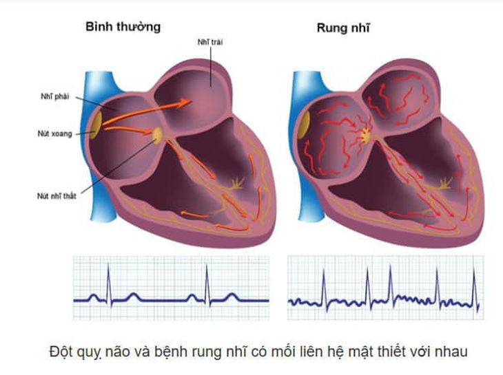 Biểu hiện của rung nhĩ - Ảnh: BVCC