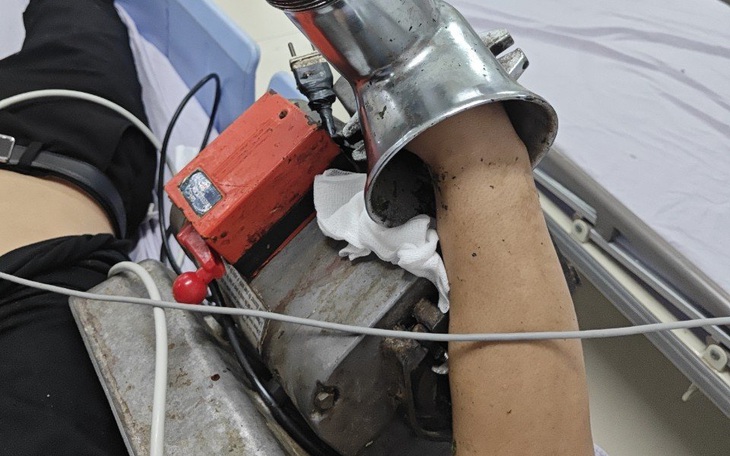 Máy xay thịt cuốn nát bàn tay nam công nhân xưởng chế biến thịt heo - Ảnh 1.