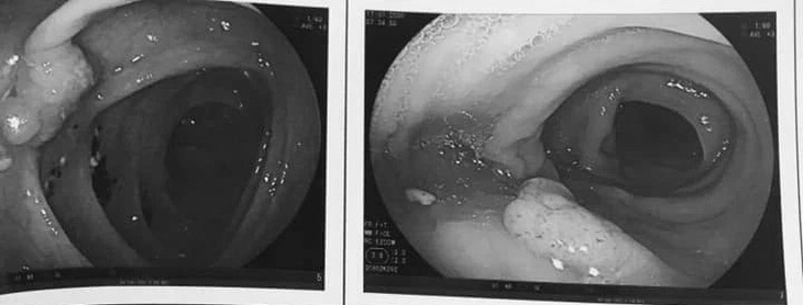 Hình ảnh polyp đại tràng qua nội soi - Ảnh: BVCC