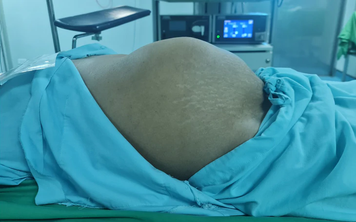 Nam giới bụng to bất thường phát hiện u nặng 12 kg - Ảnh 4.