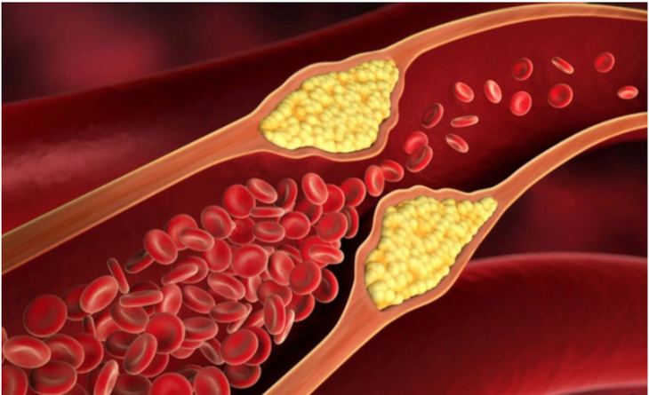 Thừa hay thiếu cholesterol đều gây nhiều bệnh lý - Ảnh minh họa