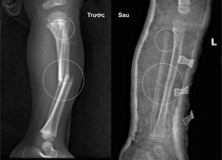 Hình ảnh xương gãy trước và sau kéo nắn, bó bột - Ảnh: BVCC