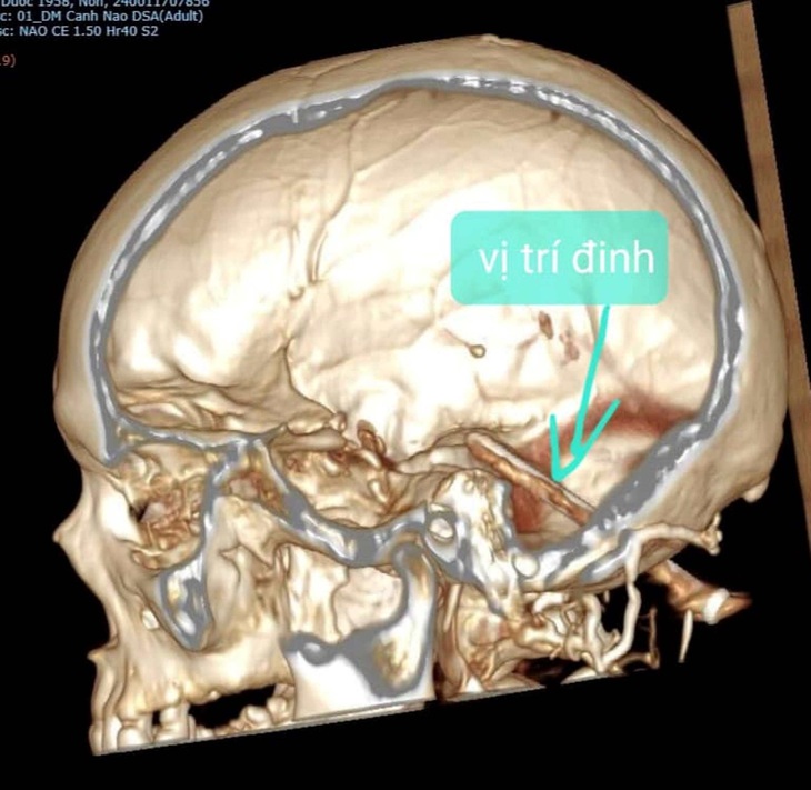 Hình ảnh chụp cắt lớp não bệnh nhân tại Quảng Bình bị cây đinh găm sâu vào tiểu não - Ảnh: NGUYỄN VĂN MẬN