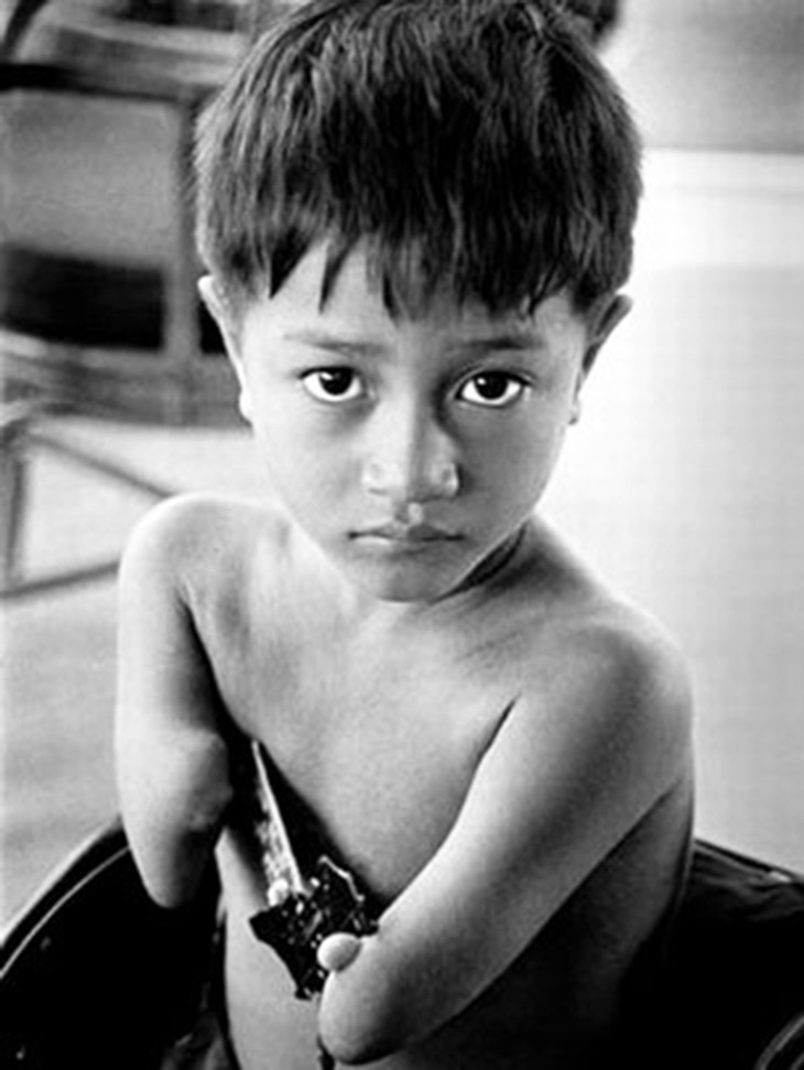 Trẻ em là nạn nhân chất độc da cam ở Việt Nam - Ảnh: Philip Jones Griffiths