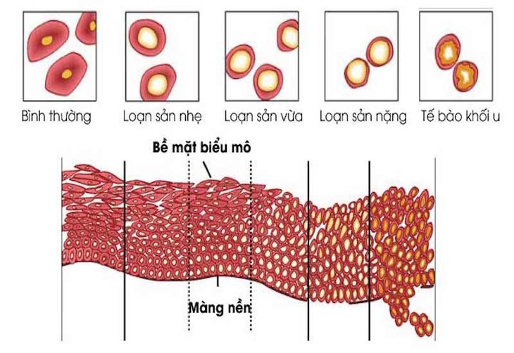 Biểu hiện của bệnh loạn sản - Ảnh: BSCC