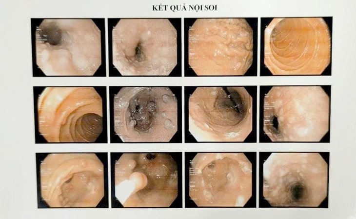 Hy hữu ca bệnh có u chi chít trong dạ dày và mọc khắp cơ thể - Ảnh 1.
