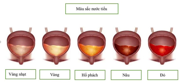 Tự 'bắt bệnh' qua màu sắc, mùi nước tiểu - Ảnh 1.