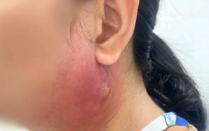 Từ nốt mụn nhỏ vùng mông, nam thanh niên 17 tuổi suy đa tạng nguy kịch - Ảnh 2.