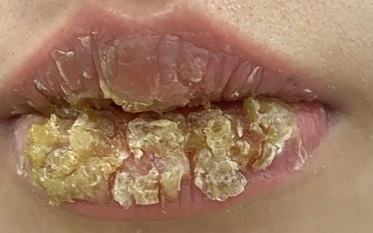 Kiểm tra thẩm mỹ viện căng da mặt gây biến chứng nặng - Ảnh 2.
