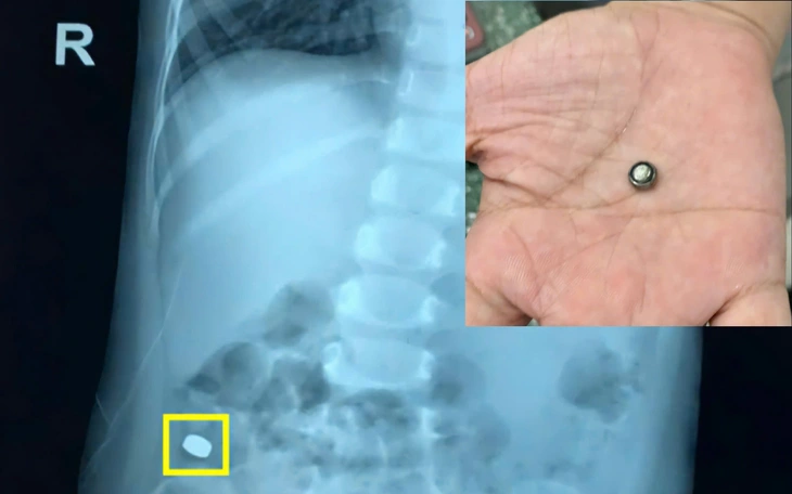 Cấp cứu bé trai nuốt phải nhiều viên nam châm - Ảnh 2.