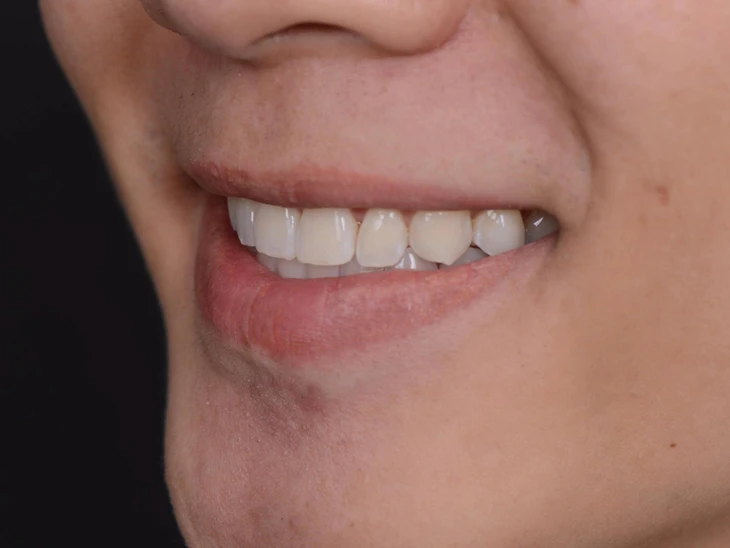 niềng răng - Ảnh 1.