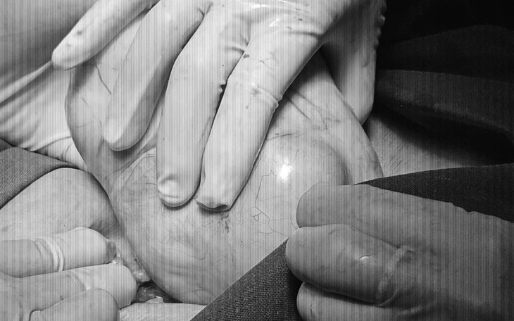 Đang mang thai, sản phụ phát hiện khối u lớn, chảy dịch trong ổ bụng - Ảnh 3.