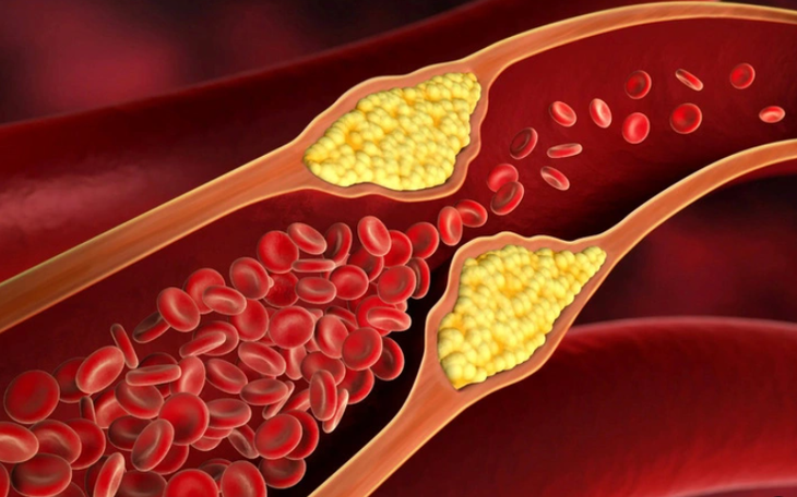 7 mẹo nhỏ giúp kiểm soát mỡ máu hiệu quả ngày Tết - Ảnh 2.